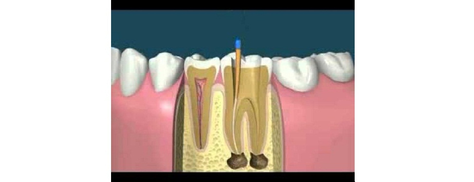 Root Canal Treatment